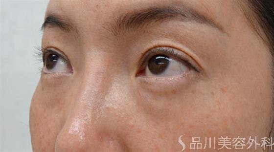 症例NO.47778のBEFORE写真