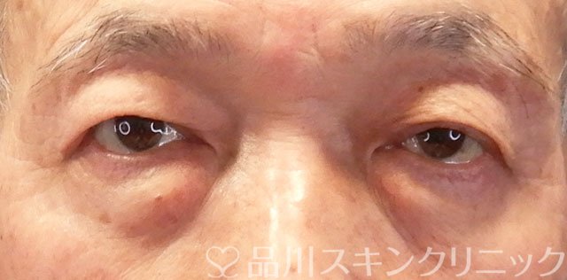 症例NO.65607のBEFORE写真