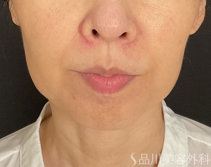 症例NO.74877のBEFORE写真