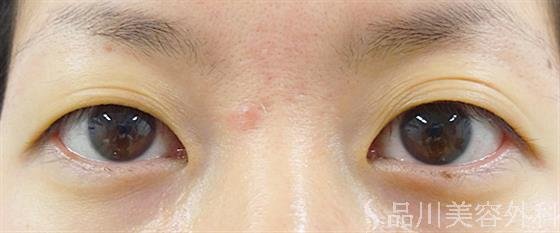 症例NO.29072のBEFORE写真