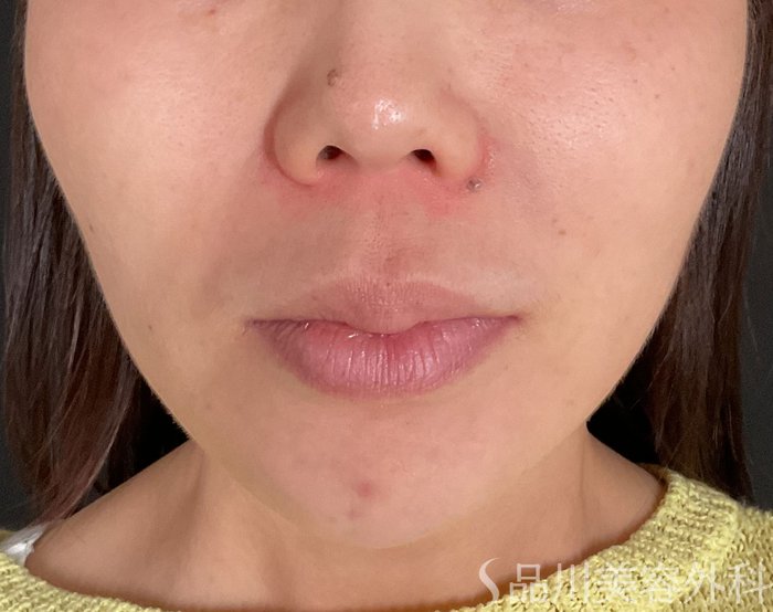 症例NO.75192のBEFORE写真