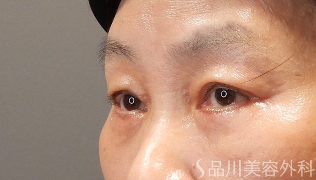 症例NO.74809のAFTER写真