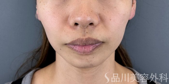 症例NO.71413のBEFORE写真