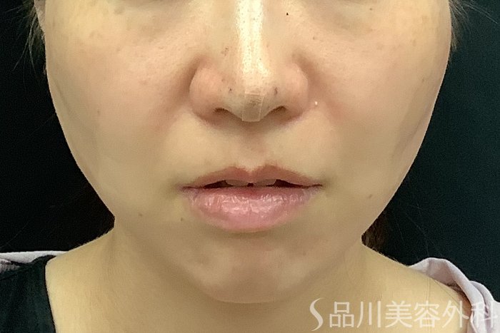 症例NO.71250のAFTER写真