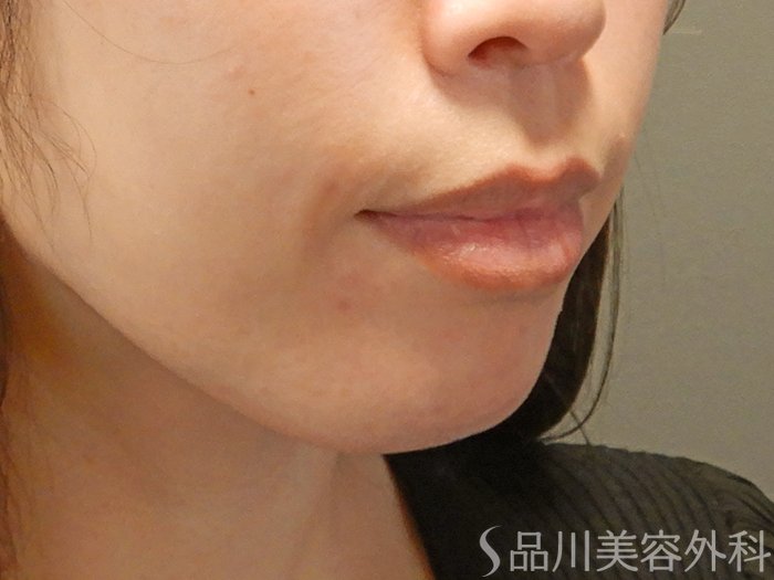 症例NO.69423のBEFORE写真