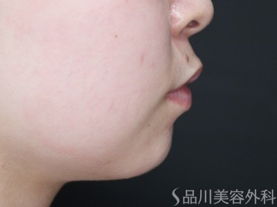 症例NO.69966のBEFORE写真