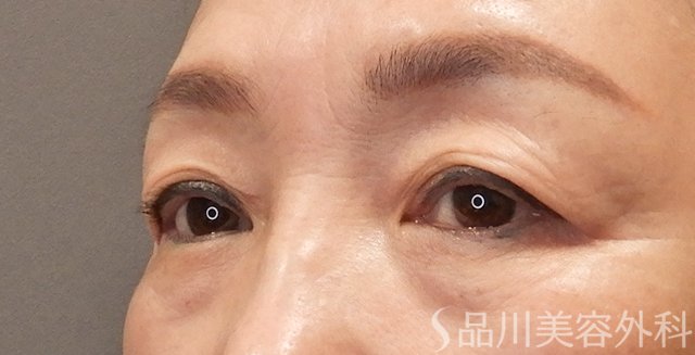 症例NO.73283のBEFORE写真