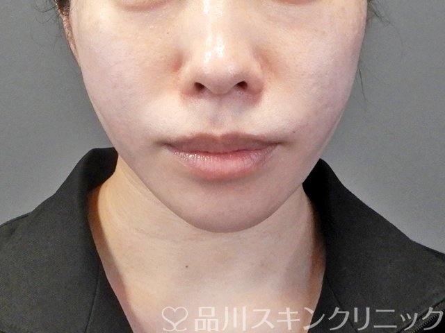 症例NO.66746のAFTER写真