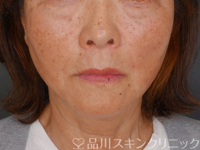 症例NO.73018のAFTER写真