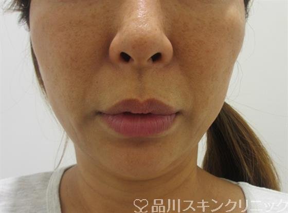 症例NO.33314のAFTER写真