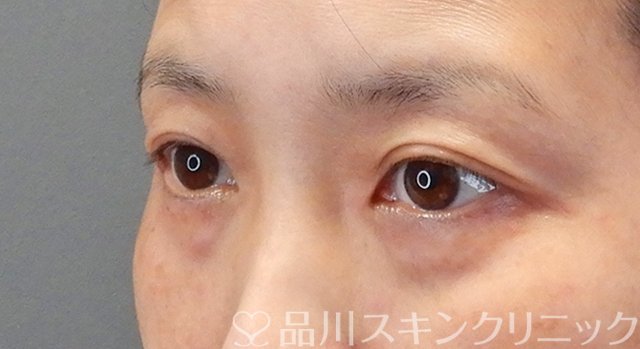 症例NO.75250のBEFORE写真