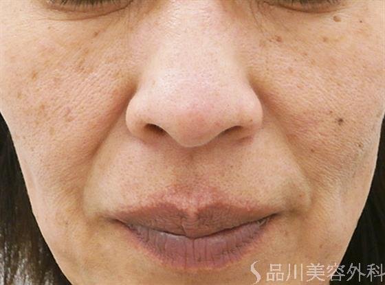 症例NO.23671のBEFORE写真