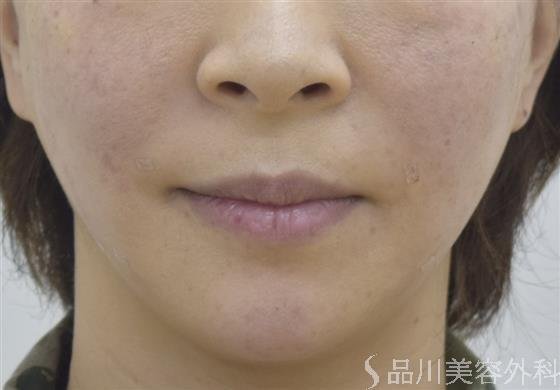 症例NO.45253のAFTER写真