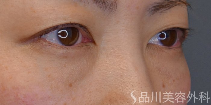 症例NO.72943のBEFORE写真