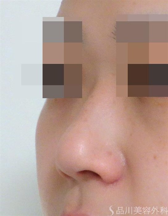 症例NO.47180のAFTER写真