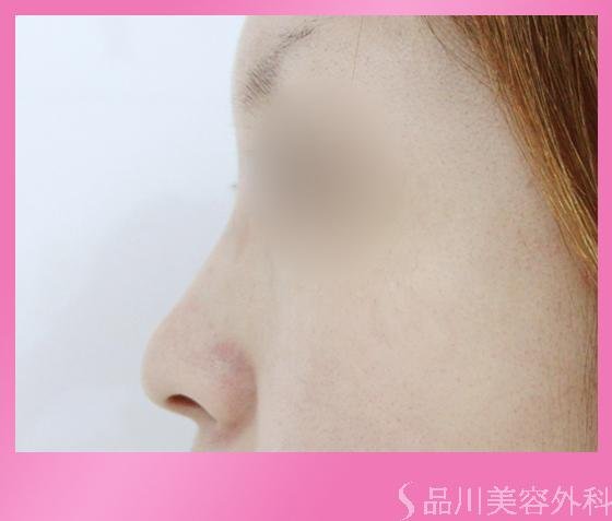 症例NO.2059のBEFORE写真