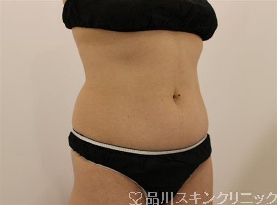 症例NO.49451のBEFORE写真