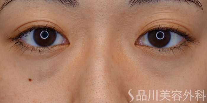 症例NO.71602のBEFORE写真