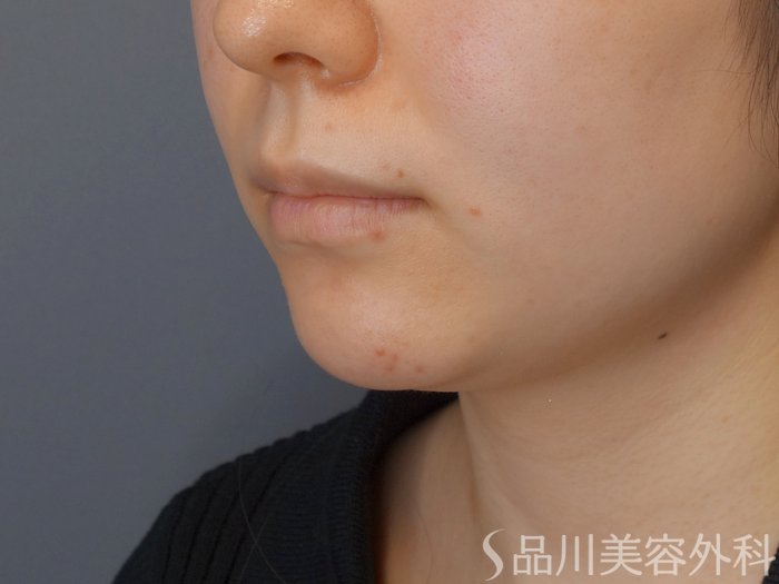 症例NO.72146のBEFORE写真