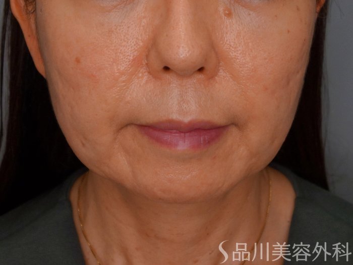 症例NO.74180のBEFORE写真