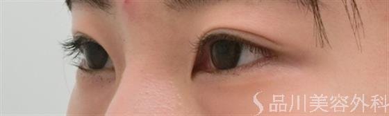 症例NO.27718のAFTER写真