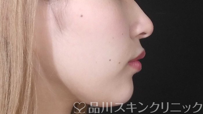 症例NO.71640のAFTER写真