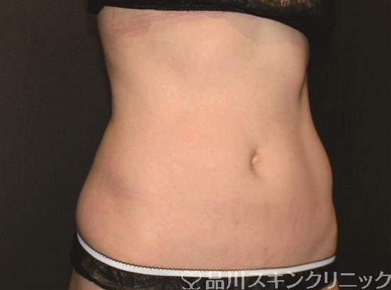 症例NO.56972のAFTER写真
