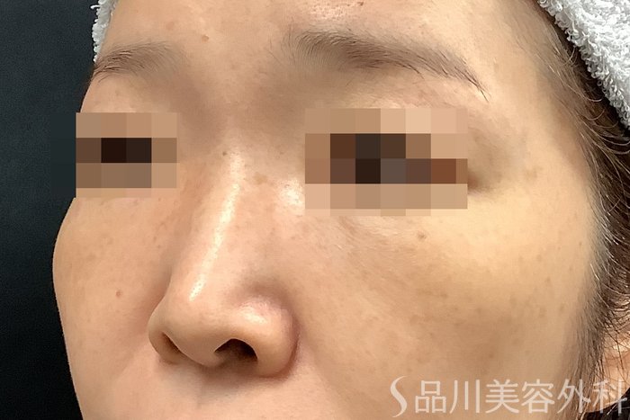 症例NO.71256のBEFORE写真