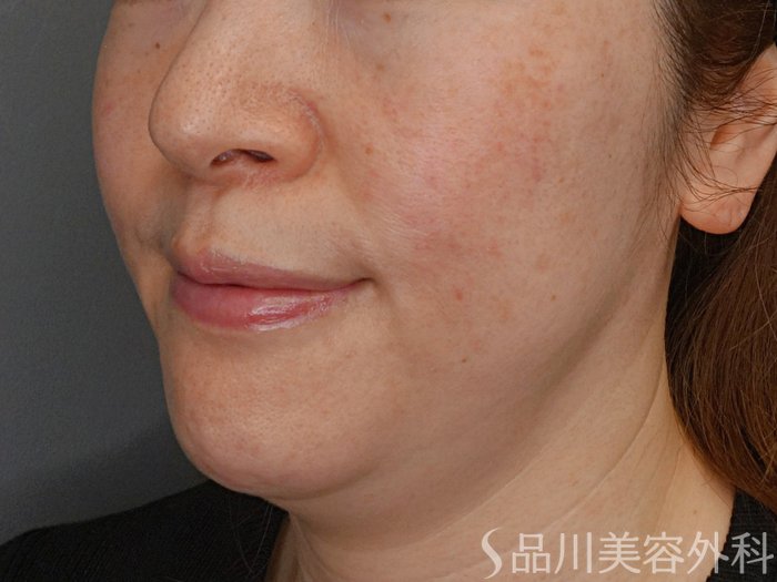 症例NO.74302のBEFORE写真