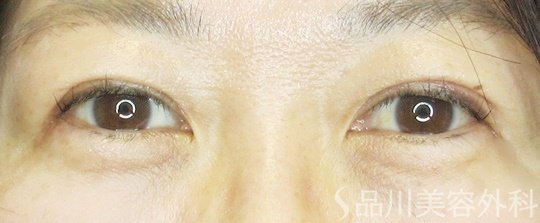 症例NO.69418のAFTER写真