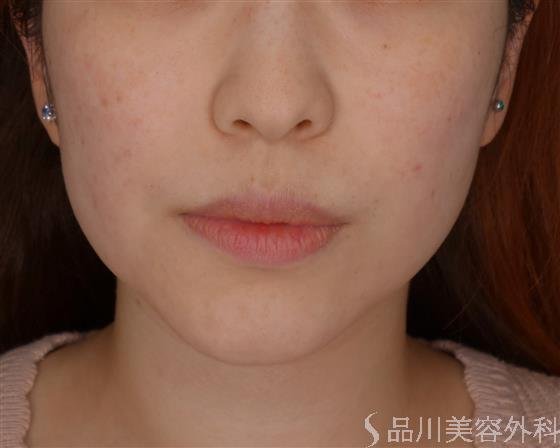 症例NO.51167のBEFORE写真