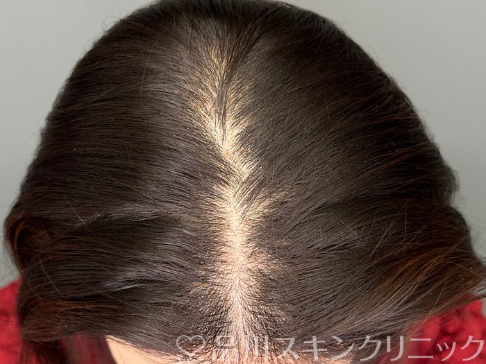 症例NO.73413のBEFORE写真