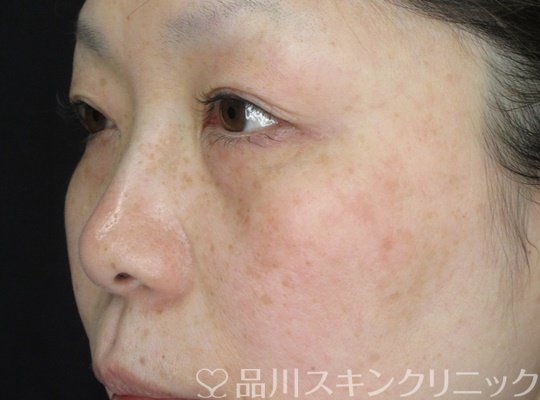 症例NO.69728のBEFORE写真