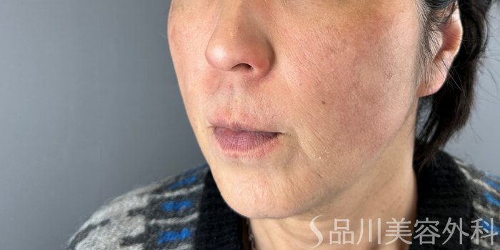 症例NO.74481のBEFORE写真