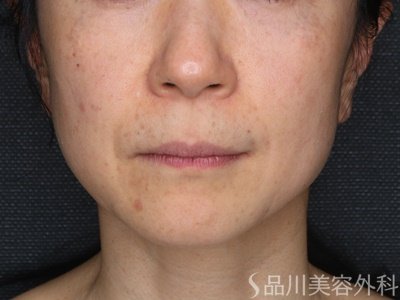 症例NO.69237のBEFORE写真