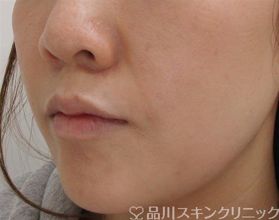 症例NO.39601のAFTER写真