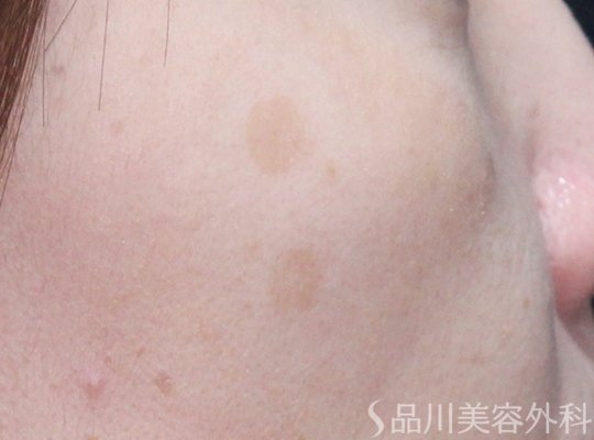 症例NO.74229のBEFORE写真