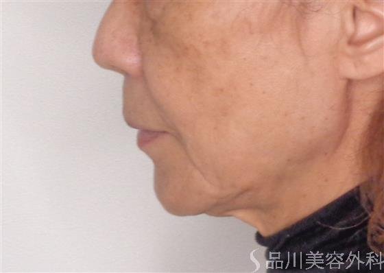 症例NO.47833のBEFORE写真