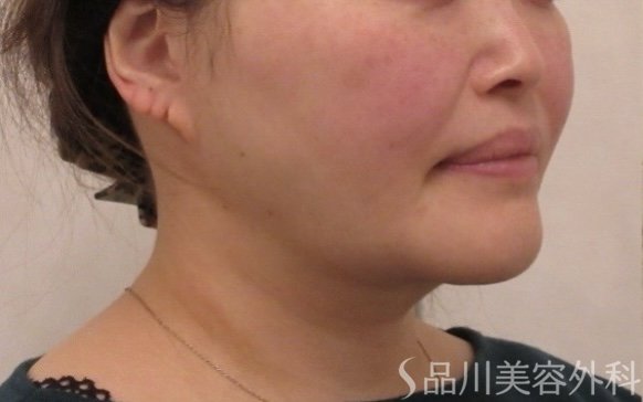症例NO.75167のBEFORE写真