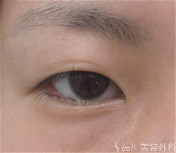 症例NO.23393のBEFORE写真
