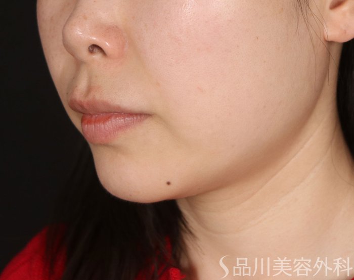 症例NO.73007のBEFORE写真