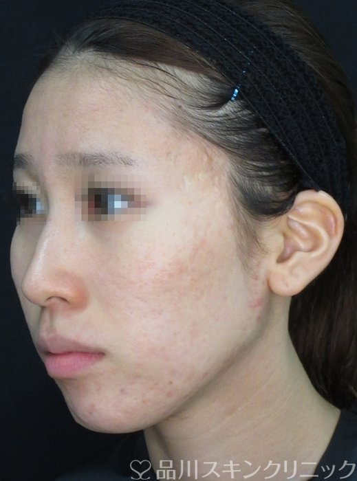 症例NO.72056のBEFORE写真