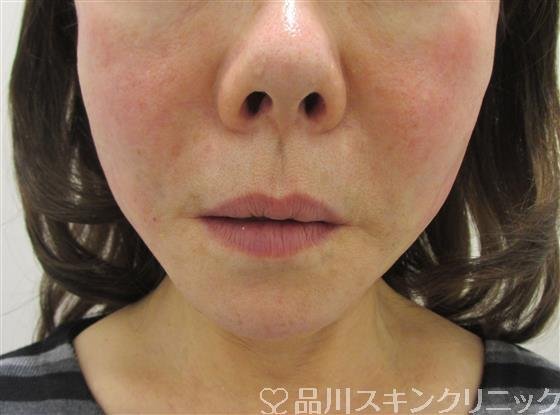 症例NO.33028のAFTER写真
