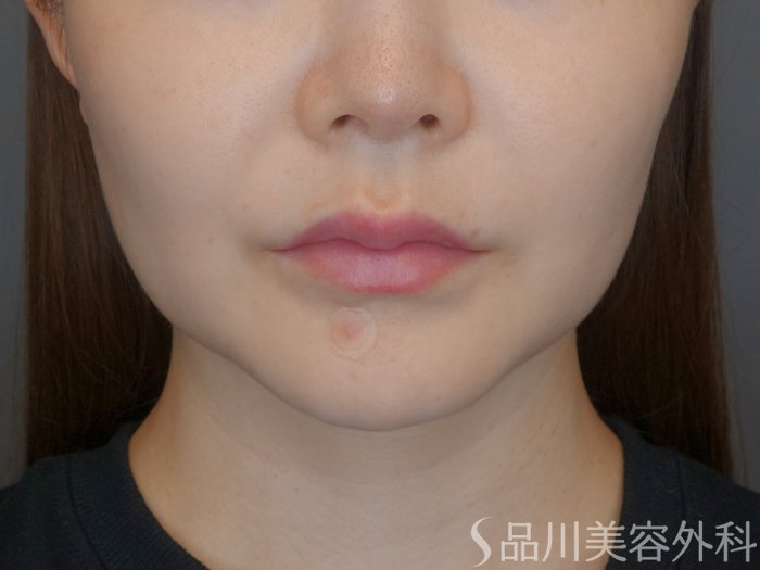 症例NO.70623のBEFORE写真