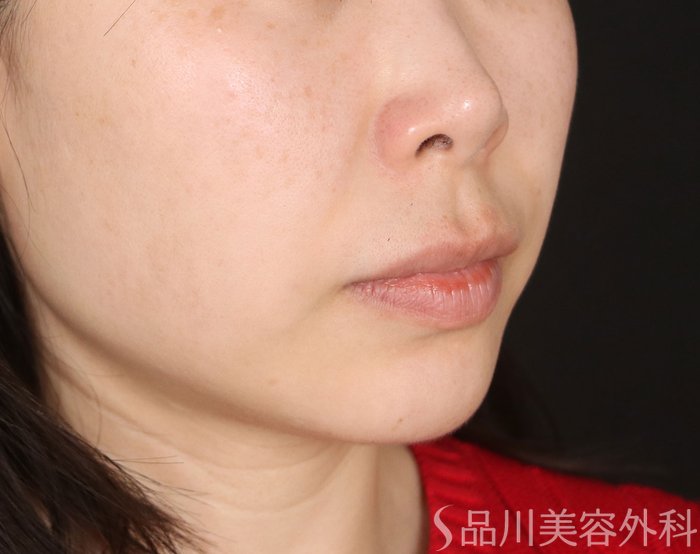 症例NO.73315のBEFORE写真