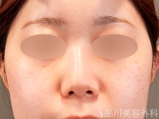 症例NO.69913のAFTER写真