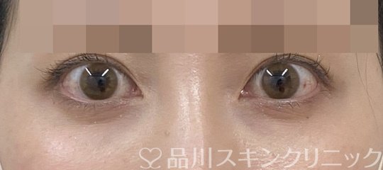 症例NO.64288のBEFORE写真