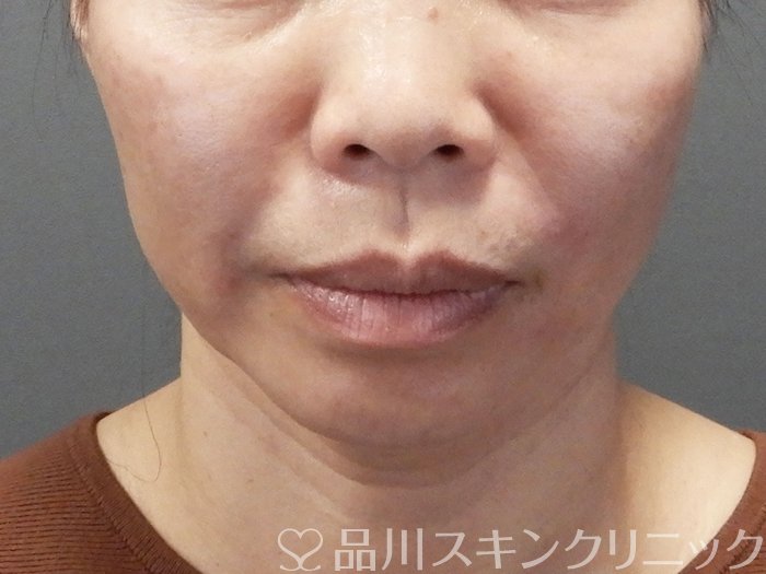 症例NO.73479のAFTER写真