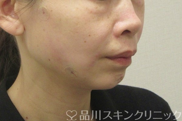症例NO.74830のAFTER写真