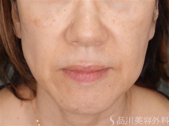 症例NO.53352のBEFORE写真